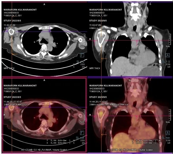 PET-CT findings in patients with multiple myeloma