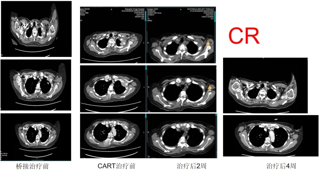 Effect of car-t cell therapy on multiple myeloma